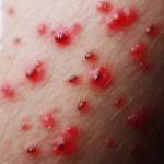 Czy to ugryzienie pchły, czy pluskwy?